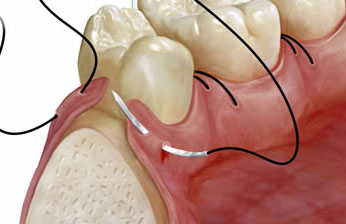 cirugia bucal